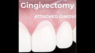 Esthetic Gingival Recontouring after Orthodontic Treatment [upl. by Aoht]