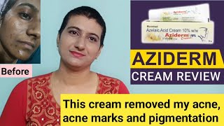 This cream removed my acne acne marks and pigmentation  Aziderm azelaic acid cream review telugu [upl. by Akemihs]