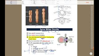 Neurosurgery  Neural tube defect [upl. by Yslehc]