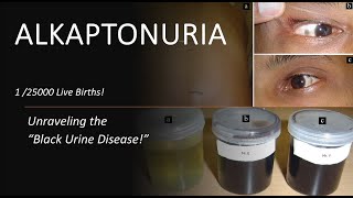 Unraveling ALKAPTONURIA The Mysterious Black Urine Disease [upl. by Andree701]