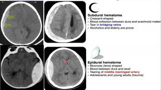 Emergency Neuroradiology Session 1 Spontaneous ICH amp Brain Aneurysms [upl. by Akienaj213]