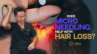 Is Microneedling The Cure For Hair Loss [upl. by Aizti]