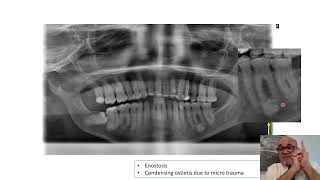 Periapical Radiopacities [upl. by Revlys569]