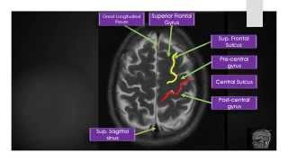 MRI Brain Sectional Anatomy Section 2 [upl. by Zurkow152]