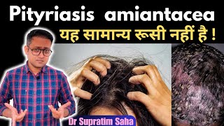 What is pityriasis amiantacea  Treatment  Hindi  Dr Supratim Saha [upl. by Ssor593]