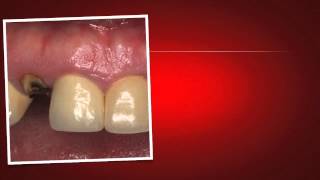 Implant Case 7  Dr Tarun Agarwal Part 1 Case introduction [upl. by Aleirbag]