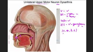 Unilateral Upper Motor Neuron Dysarthria  example and tutorial [upl. by Benson]