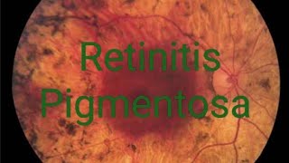 Retinitis pigmentosa RP treatment signs symptoms discussion  Simple version [upl. by Faustina]