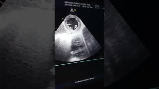 Cardiomyopathy Echo  Low EF Echo  Myocarditis Echo shorts youtubeshorts viralvideo [upl. by Ruder9]