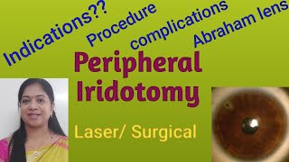 Laser peripheral iridotomyProcedureindicationsAbraham lensComplications Incisional iridectomy [upl. by Bearce]