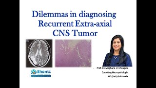 Recurrent Extraaxial CNS Tumor [upl. by Charmion]