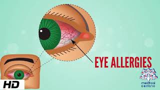 Eye Allergy Causes Signs and Symptoms Diagnosis and Treatment [upl. by Kcirrez257]