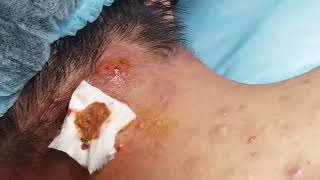 Extract Acne in Nape  HHV Clinic [upl. by Angelica]