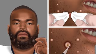 ASMR Shaving Ingrown hair Removal Animation  Relaxing Animation [upl. by Ramuk]