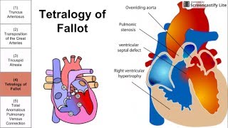 Cyanotic Congenital Heart Diseases [upl. by Spurgeon]