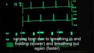 breath induced speeding up  slowing down of heart rhythm [upl. by Atteragram]