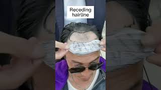 Hair Patches  Revolutionary Solution to Your Receding Hairline LaVivid Hair [upl. by Nivrek]