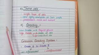 Prostate Carcinoma Pathology  Morphology and Gleason Grading [upl. by Norha]