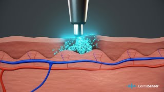 Skin Cancer Detection with DermaSensor [upl. by Ylrae]