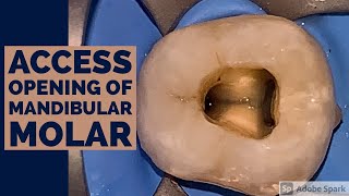 Access Opening of Mandibular Molar [upl. by Arannahs]