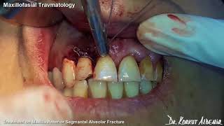 Maxillofacial Travmatology  Treatment On Maxilla Anterior Segmental Aveolar Fracture [upl. by Nitram]