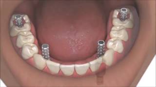 AllOn4 Dental Implants Coventry Best Same Day Full Whole Mouth Teeth Implants At Verum Dentists [upl. by Leasi402]