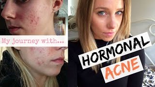 Hormonal Acne  The Pill Curing My Hormonal Acne Naturally [upl. by Iddo]