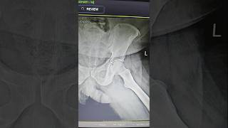 Fracture of ilium bone hip jointparamedicalclasses anatomy [upl. by Alimac]