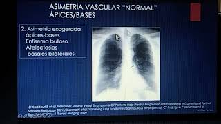 Parénquima pulmonar y cardiopatía cesar Pedroza [upl. by Jacky]