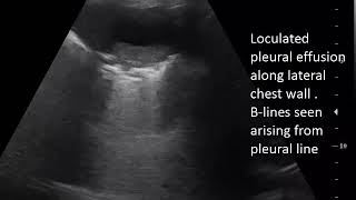 CASE 640 lung ultrasound bilateral loculated pleural effusion [upl. by Yeznil]