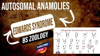 Edward syndrome  in urdu hindi  Genetics BS Zoology [upl. by Rehttam]