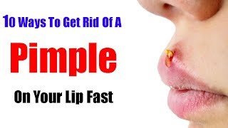 10 Ways To Get Rid Of A Pimple On Your Lip Fast [upl. by Krucik37]