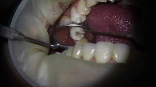 Root canal treatment RCT on lower premolar tooth  1 min video [upl. by Ezarra453]