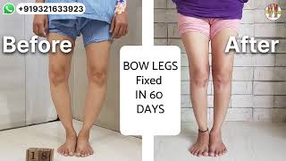 32 years old Mumbai girl operated both bowlegs BOW LEGS Fixed in 60 days Height also increased [upl. by Wesla37]