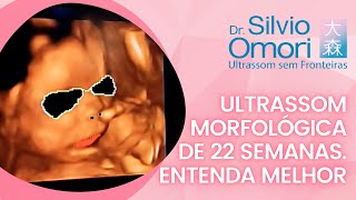 Ultrassom morfológica de 22 semanas Entenda melhor [upl. by Ennaira]