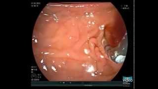 Primary Sclerosing Cholangitis and Brush Cytology Sampling [upl. by Suidaht962]