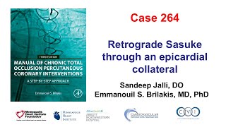 Case 264 Manual of CTO PCI Retrograde Sasuke through an epicardial collateral [upl. by Leelah702]