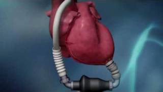 Ventricular Assist Devices [upl. by Frye]