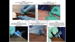 Vascular Access Cannulation Skills and Techniques [upl. by Eon]