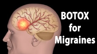 BOTOX for Migraines Animation [upl. by Thorwald]