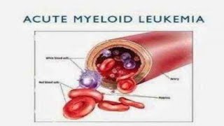 190 QampA Do you have medicine for Acute Myeloid Leukemia 4 herbal plants [upl. by Bergstrom]