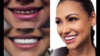 Fixing Gapped Teeth Without A Dentist See Why Cosmetic Dental Veneers Are Better Than Braces [upl. by Valentina234]