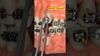 DENTAL BRACES ORTHODONTICS treatments [upl. by Kerril]