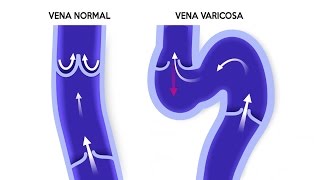 ¿Por qué no debes hacer pesas si tienes varices [upl. by Lexa]