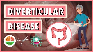 Diverticular Disease  Emphasis on DietNutrition [upl. by Wiseman863]