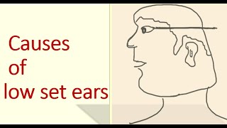 low set ears causes [upl. by Tarttan]