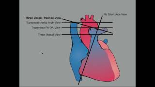 PFO Closure [upl. by Dniren]