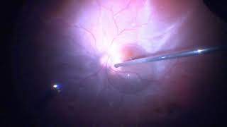 Surgery Vitrectomy for Retinal Detachment Assortment of Cases [upl. by Osner119]