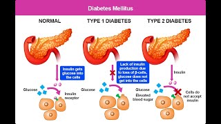 Differences between Type 1 and Type 2 Diabetes Mellitus [upl. by Burrill692]