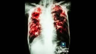 enfisema polmonare  cause  sintomi [upl. by Malissia]